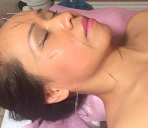 Acupuncture Treatment